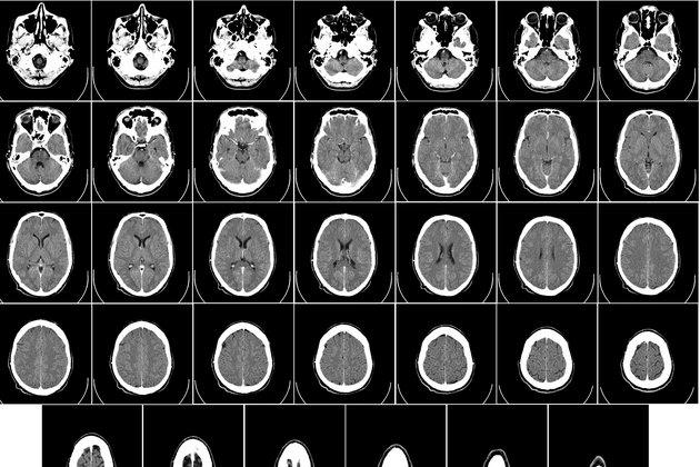 Demenz und Alzheimer sind heilbar
